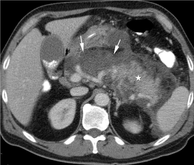 Imaging Assessment Of Etiology And Severity Of Acute Pancreatitis   Fig 2 0.JPG